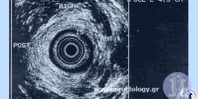 Φυσιολογικό υπερηχογράφημα πρωκτού