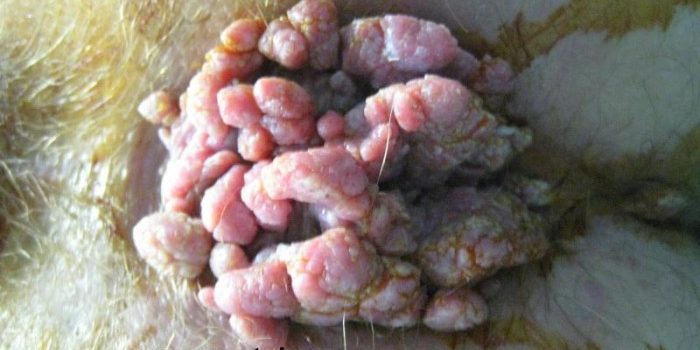 hpv big warts papilloma virus lavaggio biancheria