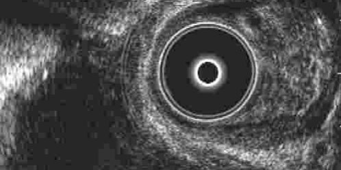 συρίγγιο – Απόστημα Πρωκτού