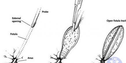 fistulotomy
